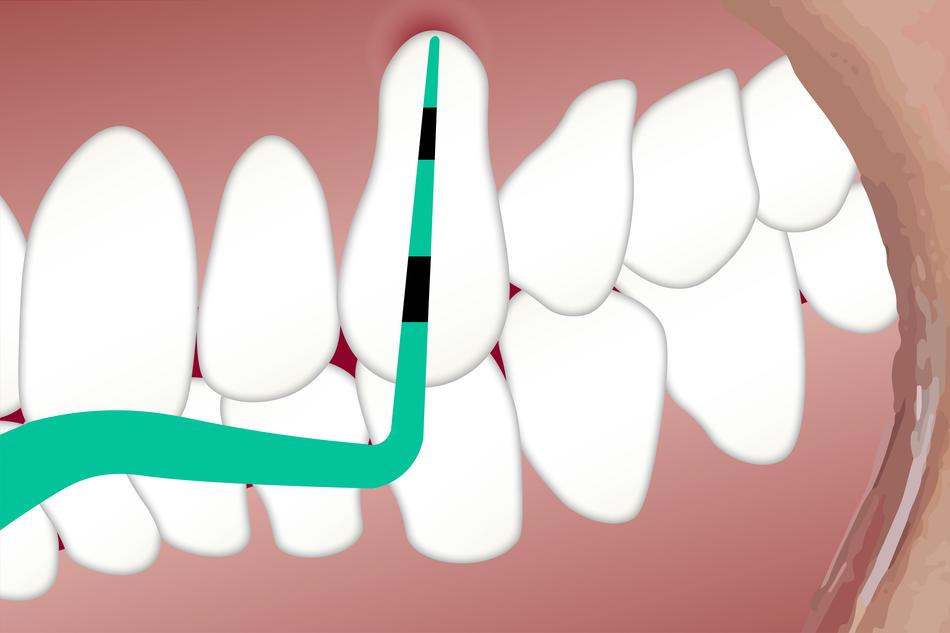 pocket depth teeth drawing