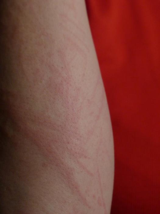 Arm Upper Reddening Of skin