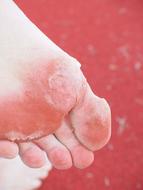 injured skin on Foot sole
