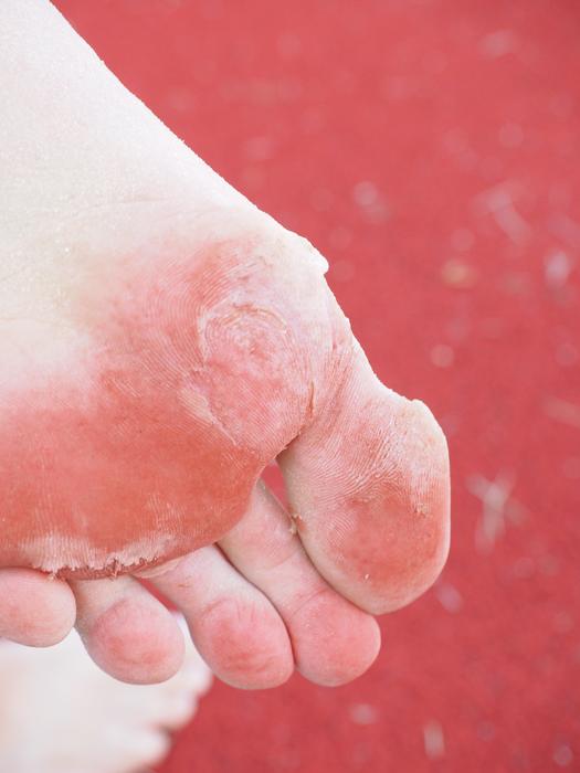 injured skin on Foot sole