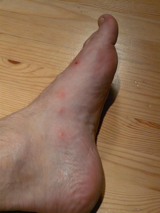 calluses on the foot