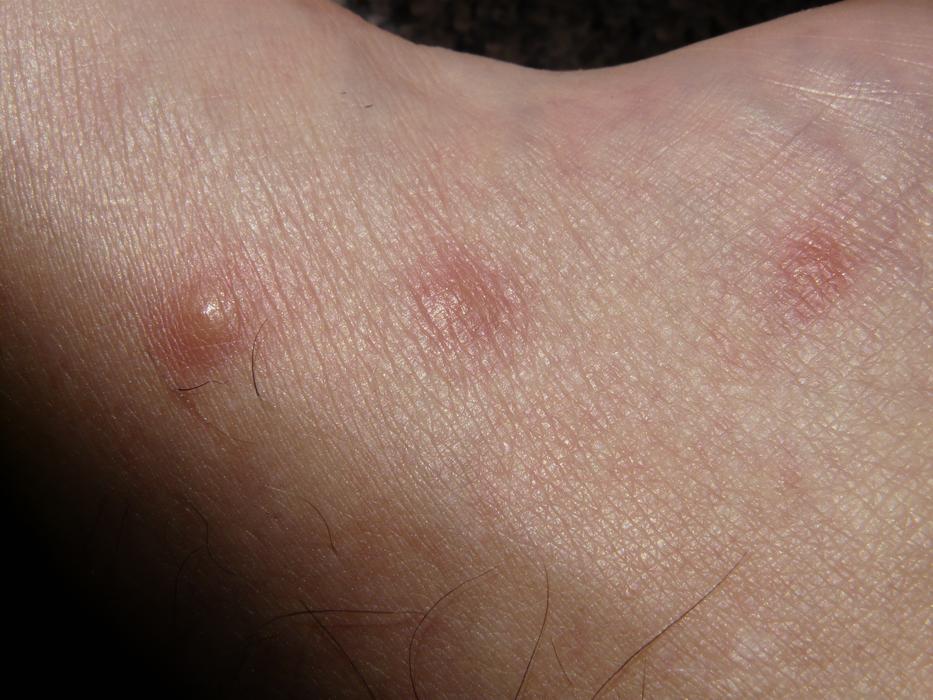 calluses on foot