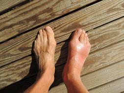 feet of a person with gout