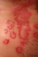 Rash Red Inflamed