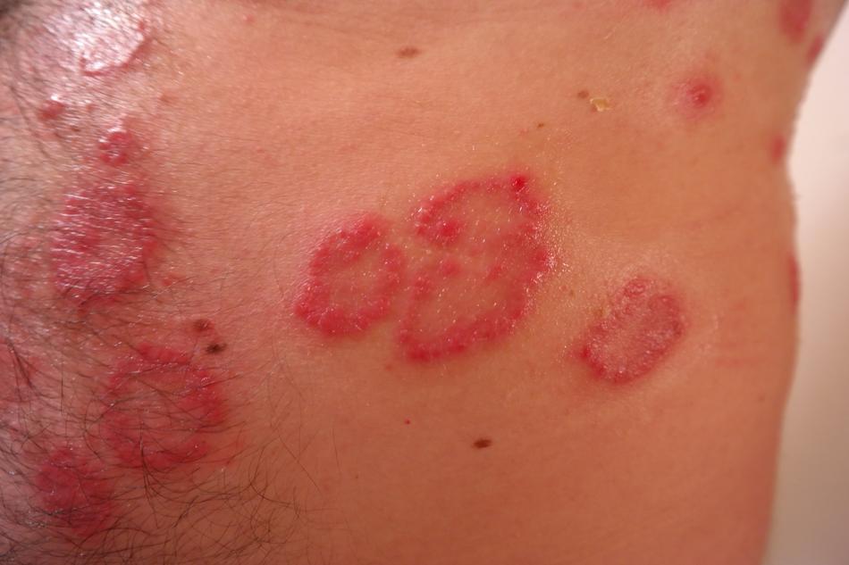 Rash Red Inflamed