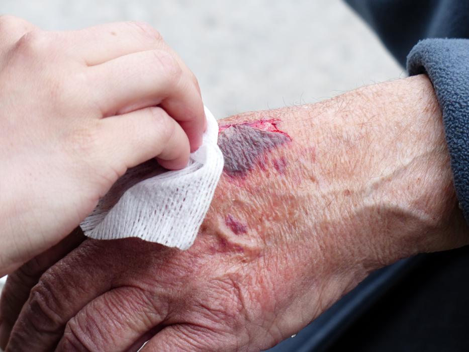 old womanâs Hand Injury healing
