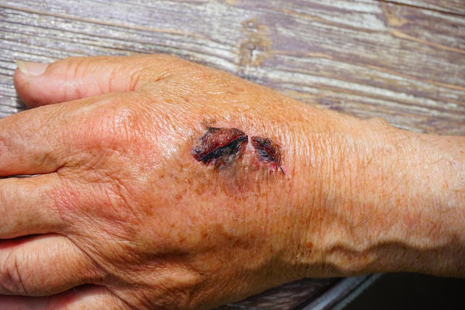 Hand Injury Skin Abrasion