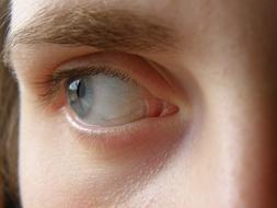 Eye Blue Iris