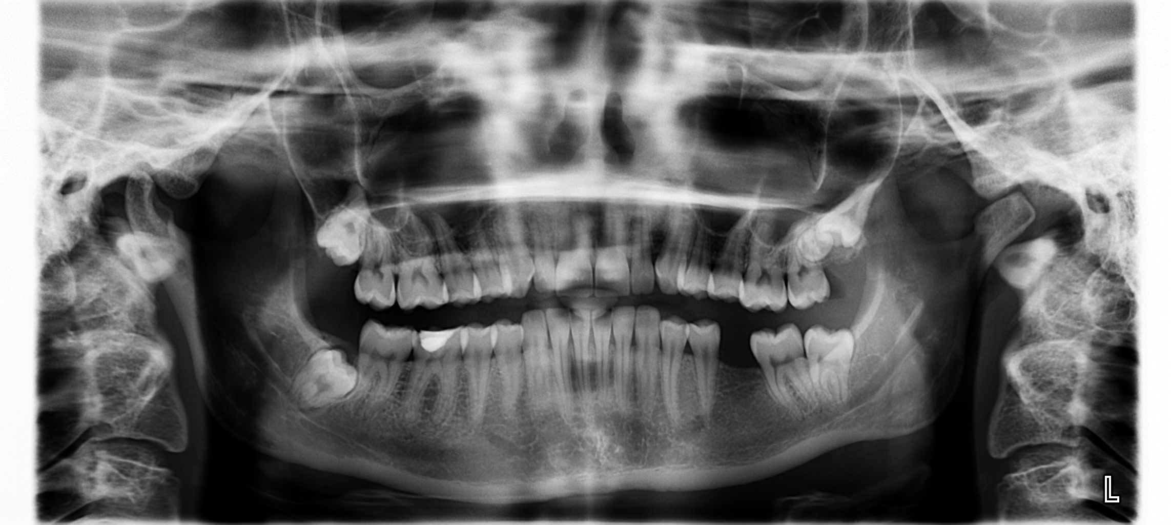 XRAY рентген