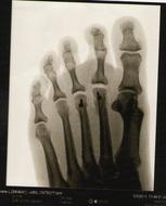 Foot Xray