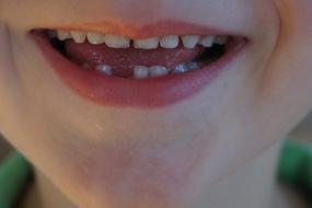 Gap Milk Tooth
