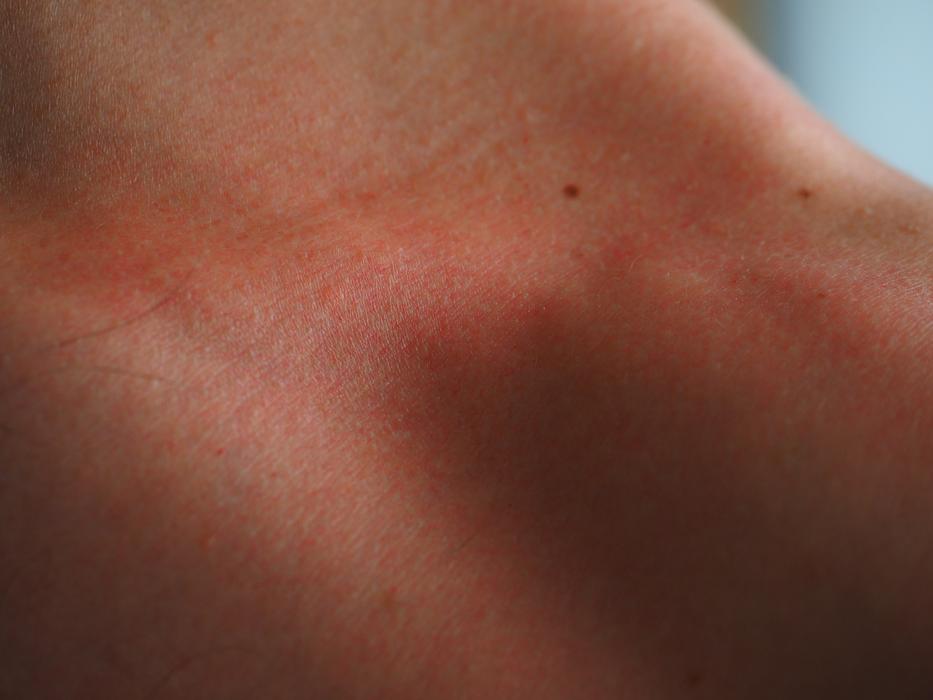 Sunburn Skin Red