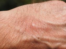 Body reaction on Mosquito Bite as mark on male hand