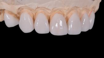 artificial white teeth