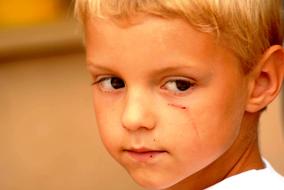 portrait of a little boy with a scratch on his cheek
