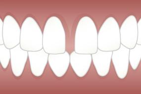 dental diastema drawing