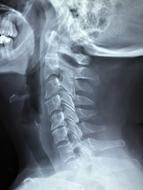 spine of a person on an x-ray in a hospital